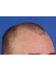 Before Hair Transplant&nbsp;Front